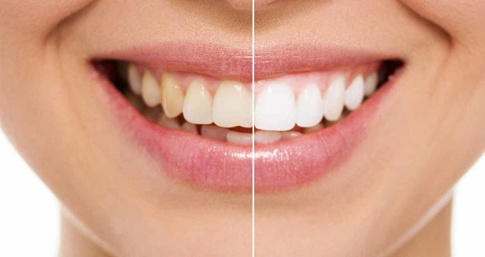 انواع شیوه های ترمیم دندان