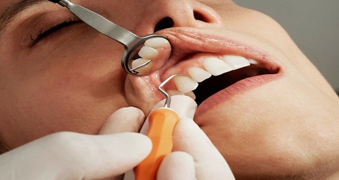 عصب کشی دندان چیست؟