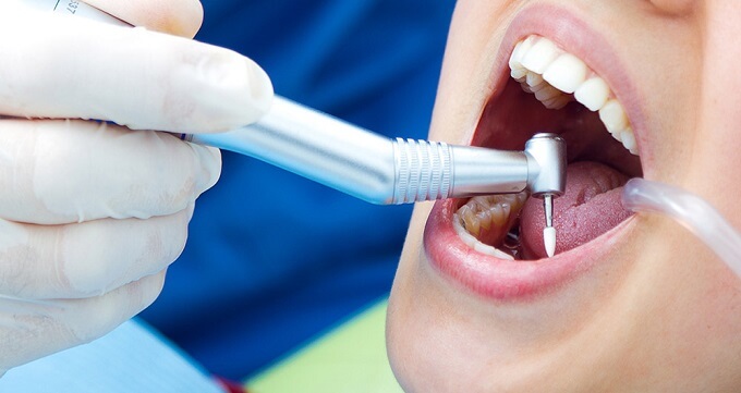 درمان ریشه دندان چگونه انجام می شود؟