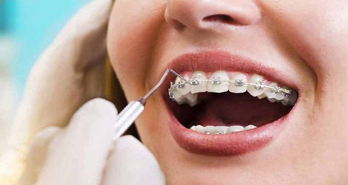 انواع ارتودنسی های دندان