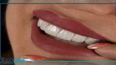 10 نکته کلیدی مراقبت از دندان بعد از لمینت