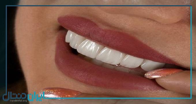 10 نکته کلیدی مراقبت از دندان بعد از لمینت
