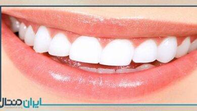 8 تفاوت لمینت و کامپوزیت دندان