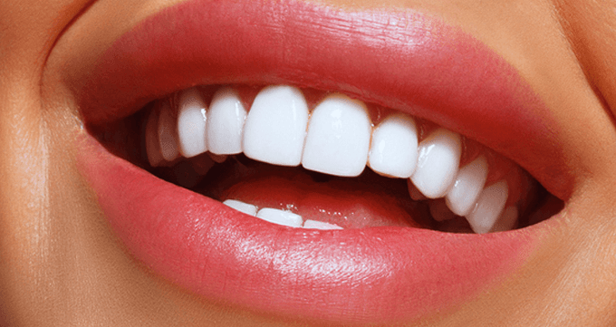 مزایا و معایب لمینت دندان