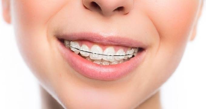 ارتودنسی دندان برای چه کسانی لازم است؟