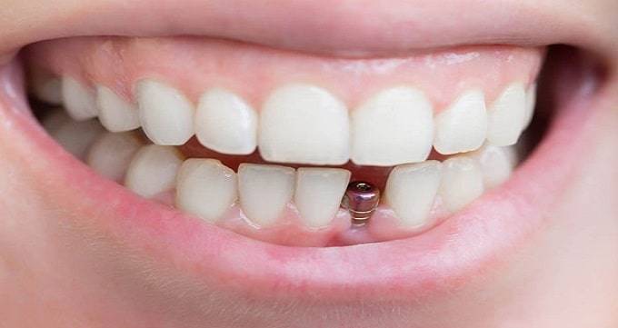 ایمپلنت دندان چیست؟ 