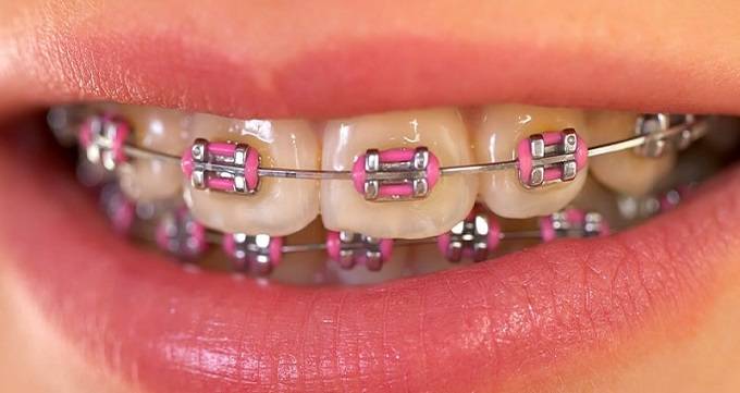 معایب های ارتودنسی دندان