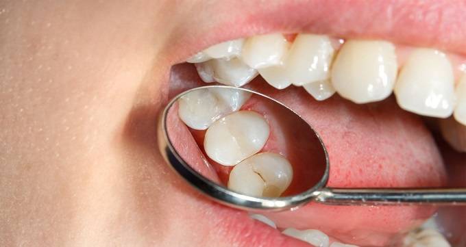 ترمیم دندان چگونه انجام می شود؟