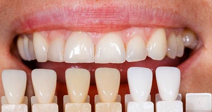مراقبت های قبل و بعد از لمینت دندان ها