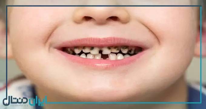 برای استحکام دندان کودکان چه کنیم؟