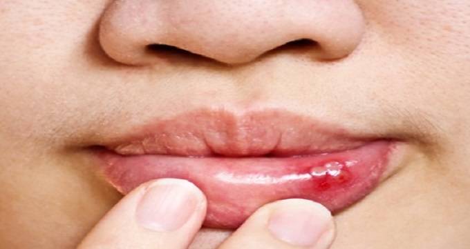 7 راهکار برای درمان آفت دهان که باید بدانید
