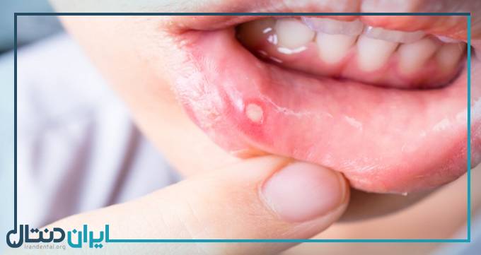 7 راهکار برای درمان آفت دهان که باید بدانید