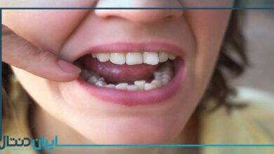 آیا دندان های کج را می شود کامپوزیت کرد؟