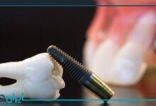 ایمپلنت یا بریج دندان؟ کدام مناسب تر است؟
