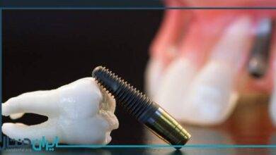 ایمپلنت یا بریج دندان؟ کدام مناسب تر است؟