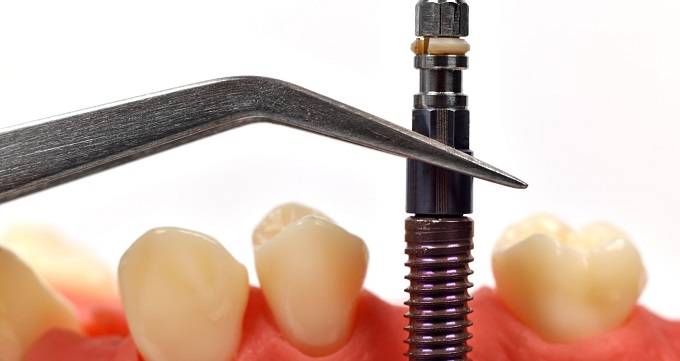 بریج دندان به چه منظور انجام می شود؟