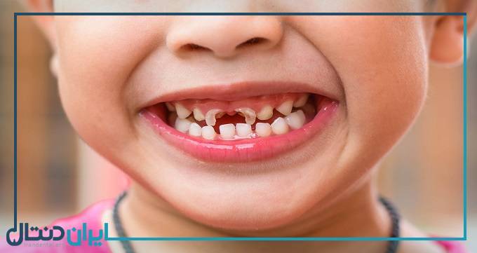 آیا قطره ی آهن سبب پوسیدگی دندان کودکان می شود؟
