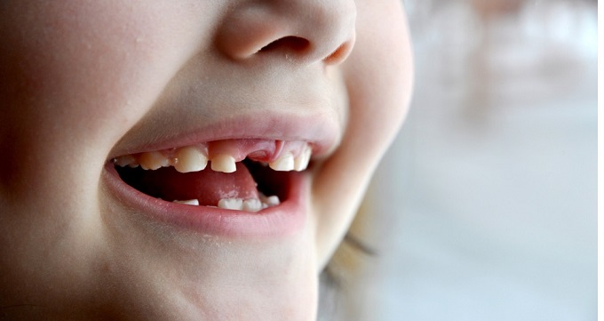 راه های درمان پوسیدگی دندان کودکان