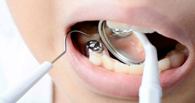 مزایا و معایب پر کردن دندان با آمالگام