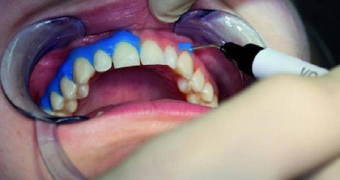 آیا بلیچینگ به دندان ها آسیب وارد می کند؟