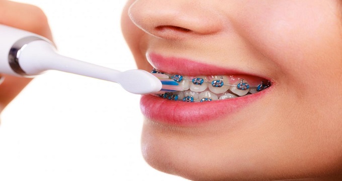 معایب ارتودنسی دندان ها