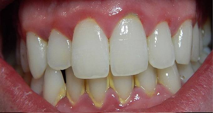 پلاک دندان چیست و چه عوارضی دارد؟