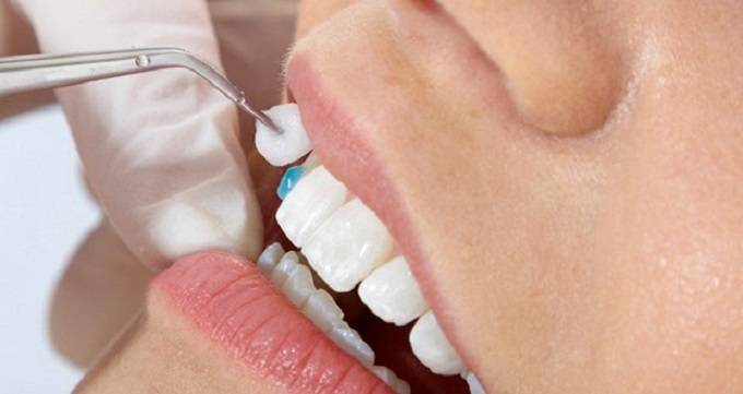 مزایای انجام لمینت دندان