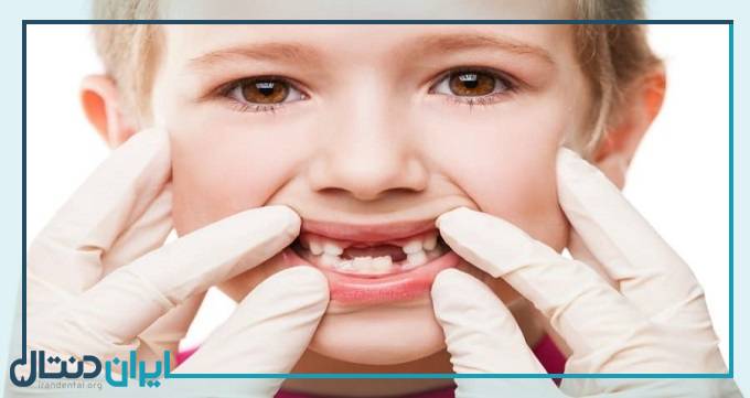 ریزه‌ خواری، مهم‌ ترین عامل پوسیدگی دندان کودکان