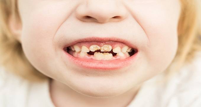 عوامل اصلی پوسیدگی دندان کودکان