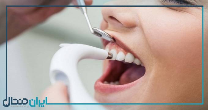 آیا لق شدن دندان بعد از جرم گیری اتفاق می افتد؟