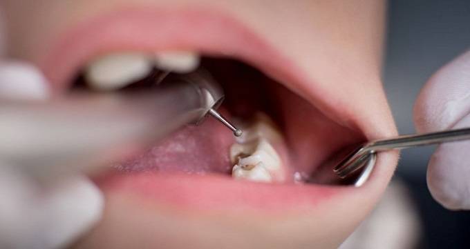 توصیه های بعد از جراحی دندان