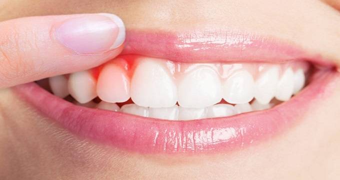 روش های خانگی درمان دندان درد