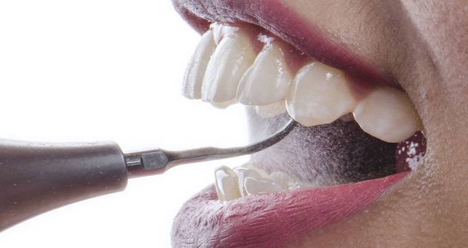 روش های جرم گیری دندان 