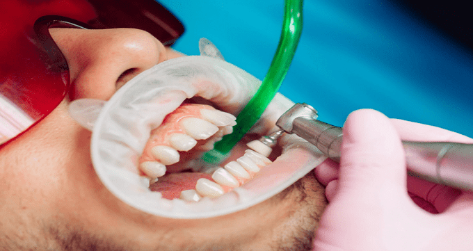 ضرر های بلیچینگ برای دندان