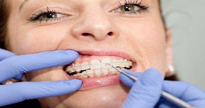 چه کسانی کاندیدای مناسبی برای ارتودنسی دندان هستند؟