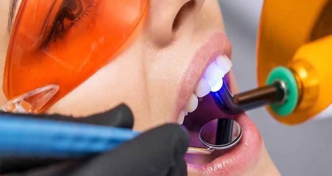 آیا کامپوزیت باعث پوسیدگی دندانها می شود؟ 