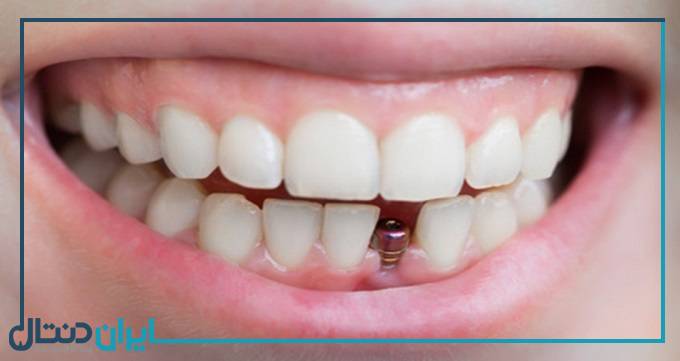 آیا ایمپلنت دندان دردناک است؟
