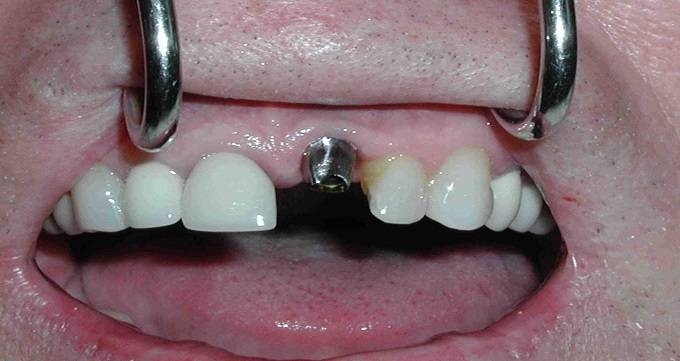 ایمپلنت بهتر است یا بریج دندان؟