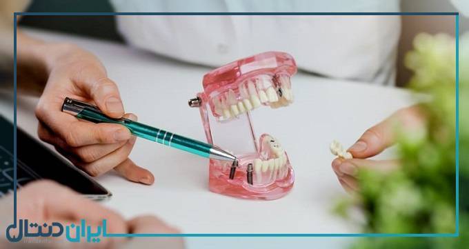 مراحل و هزینه کاشت ایمپلنت دندان