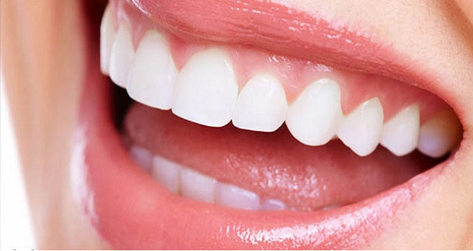 مزایای انجام مزایای بلیچینگ دندان