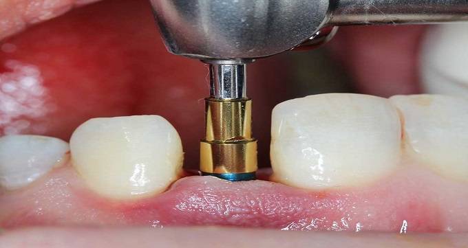 ایمپلنت دندان چیست و چقدر طول می کشد؟