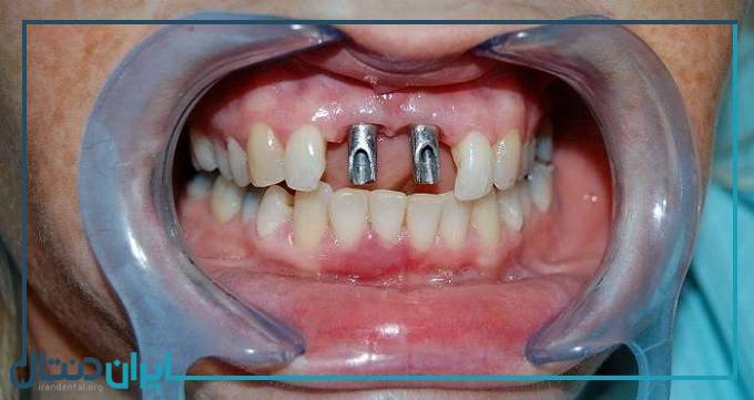 بهترین دکتر ایمپلنت دندان در تبریز