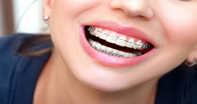 آیا ارتودنسی دندان در دارد؟