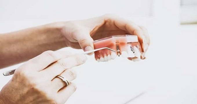 تفاوت ایمپلنت با کاشت دندان