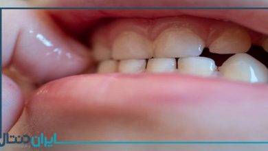 10 علت دندان قروچه کودکان در خواب