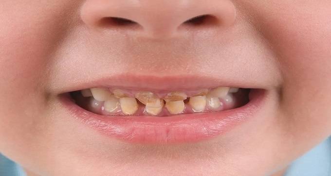 پیشگیری از تغییر رنگ دندان در کودکان