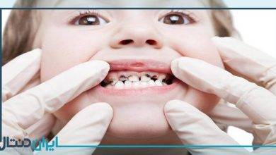 علت تغییر رنگ دندان نوزدان + درمان