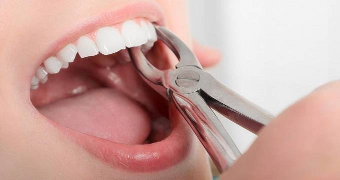 مشکلات رایج دندان عقل