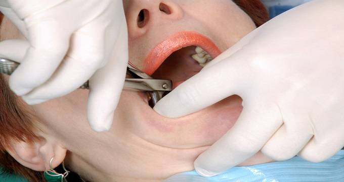 توصیه های بعد از جراحی دندان