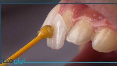 عوارض ریمو یا برداشتن کامپوزیت دندان چیست؟